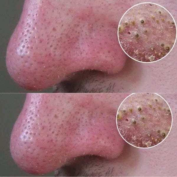 The 5 most effective remedies to remove blackheads in no time