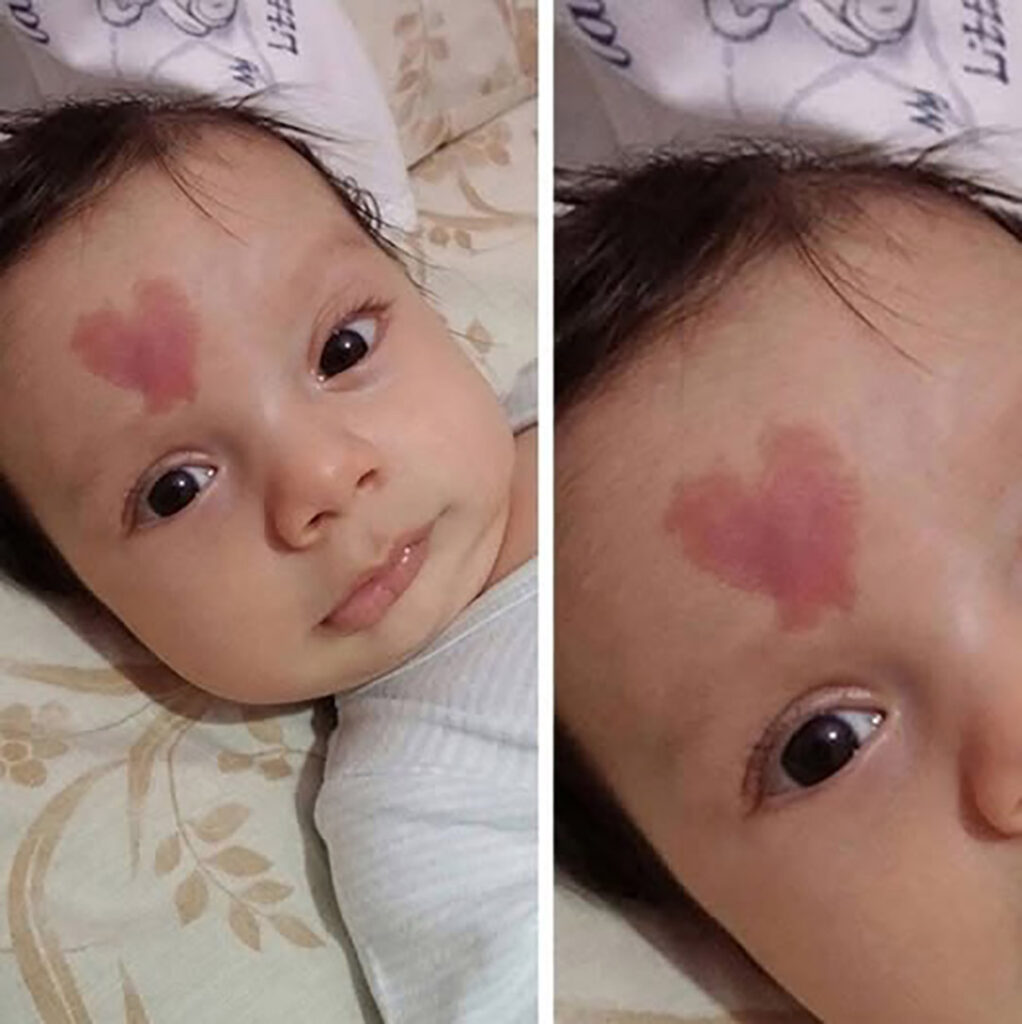 Un bébé est né avec une tache de naissance en forme de cœur sur le front. À quoi ressemblera-t-il à l’âge de 6 ans ?