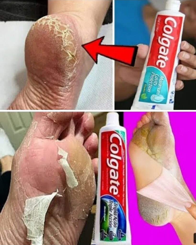 Colgate : l’astuce surprenante pour des talons parfaitement doux