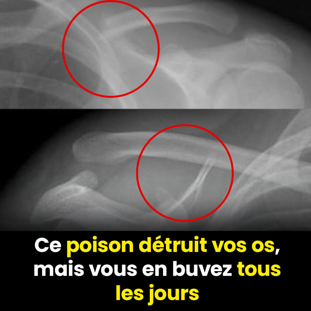 Les bulles de votre soda favori menacent-elles votre santé osseuse ?