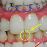 Enlevez la Plaque Dentaire dans 5 minutes Naturellement, sans Aller au Dentiste