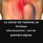 Le cancer de l’estomac se développe silencieusement : voici les premiers signes !